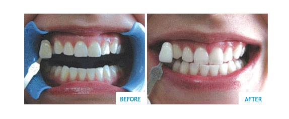 Laser teeth whitening cost dublin